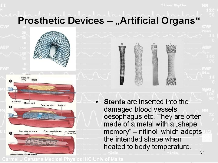 Prosthetic Devices – „Artificial Organs“ • Stents are inserted into the damaged blood vessels,