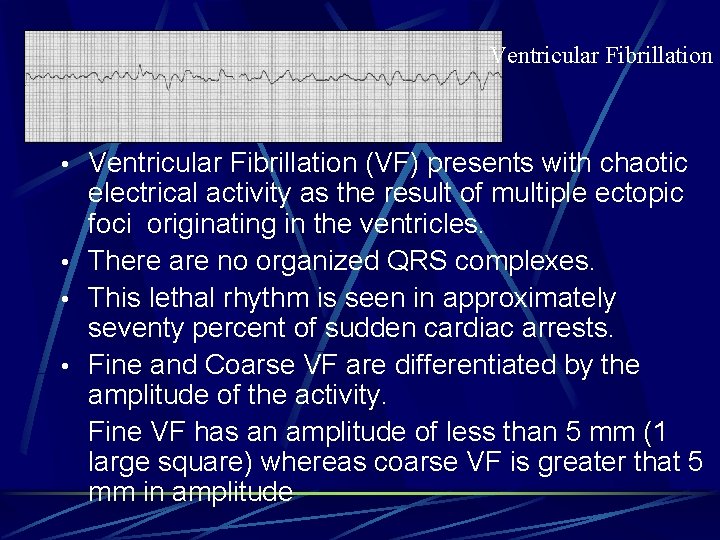 Ventricular Fibrillation • Ventricular Fibrillation (VF) presents with chaotic electrical activity as the result