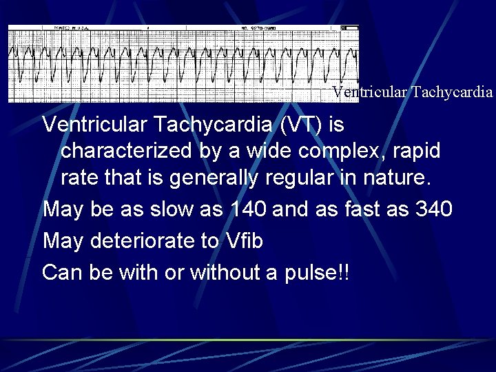 Ventricular Tachycardia (VT) is characterized by a wide complex, rapid rate that is generally