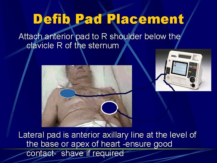 Defib Pad Placement Attach anterior pad to R shoulder below the clavicle R of