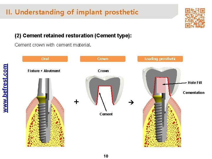 II. Understanding of implant prosthetic (2) Cement retained restoration (Cement type): www. befrest. com