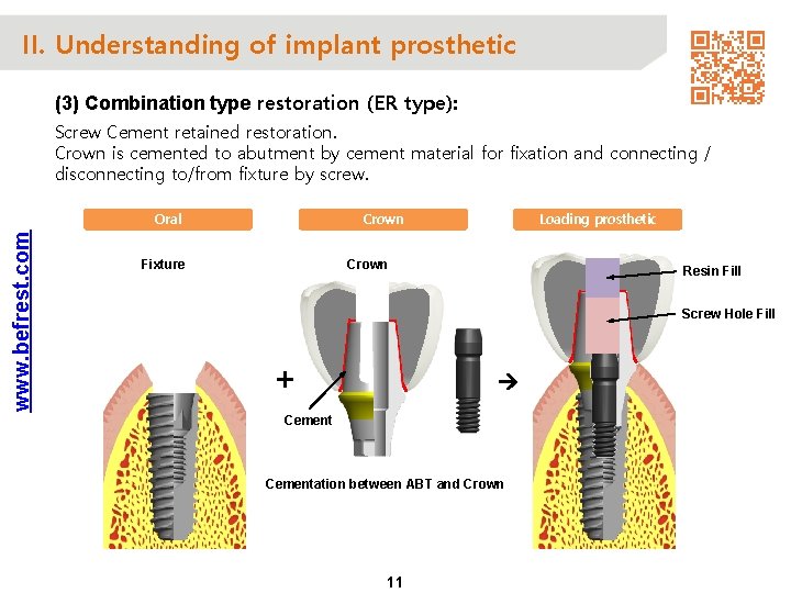 II. Understanding of implant prosthetic (3) Combination type restoration (ER type): Screw Cement retained