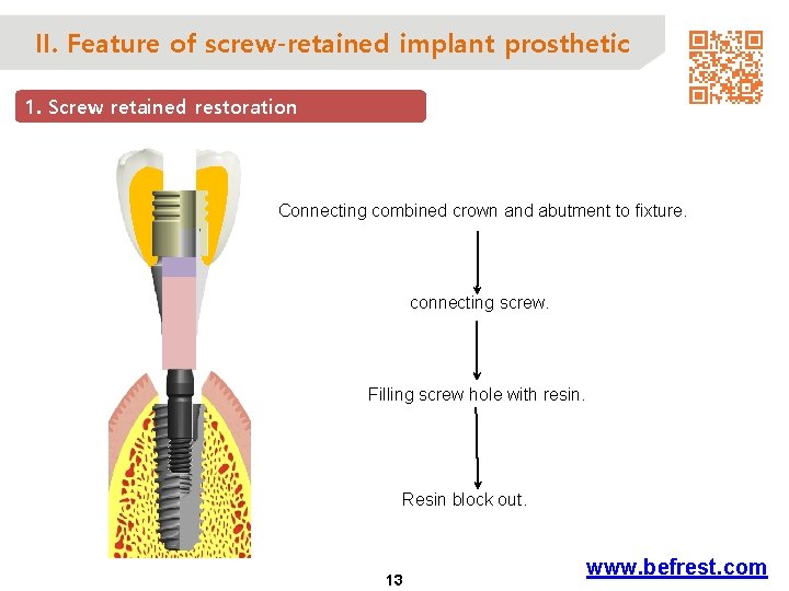 II. Feature of screw-retained implant prosthetic 1. Screw retained restoration Connecting combined crown and