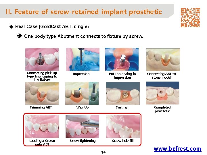 II. Feature of screw-retained implant prosthetic ◆ Real Case (Gold. Cast ABT. single) One