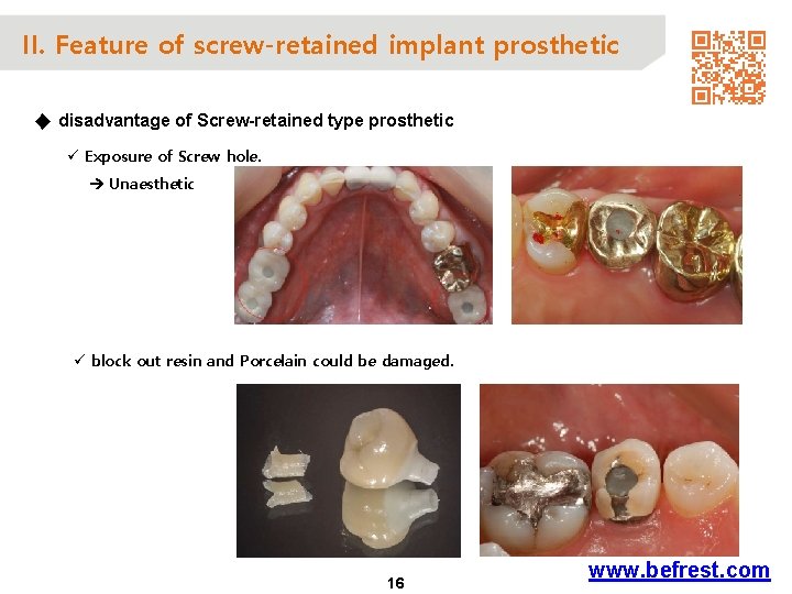 II. Feature of screw-retained implant prosthetic ◆ disadvantage of Screw-retained type prosthetic ü Exposure