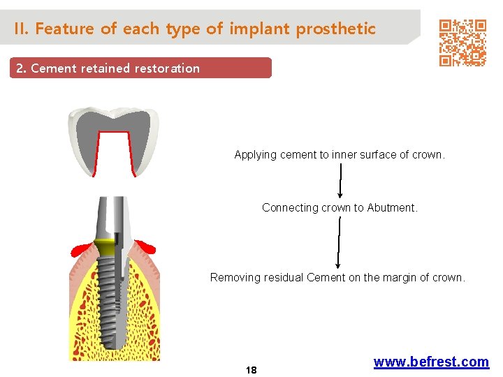 II. Feature of each type of implant prosthetic 2. Cement retained restoration Applying cement