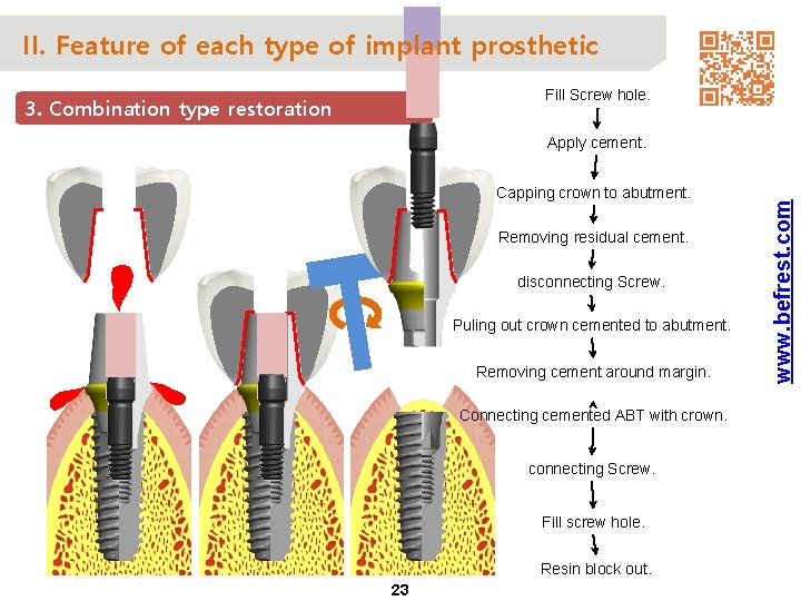 II. Feature of each type of implant prosthetic Fill Screw hole. 3. Combination type