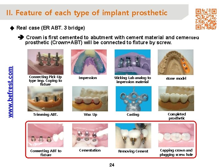 II. Feature of each type of implant prosthetic ◆ Real case (ER ABT. 3