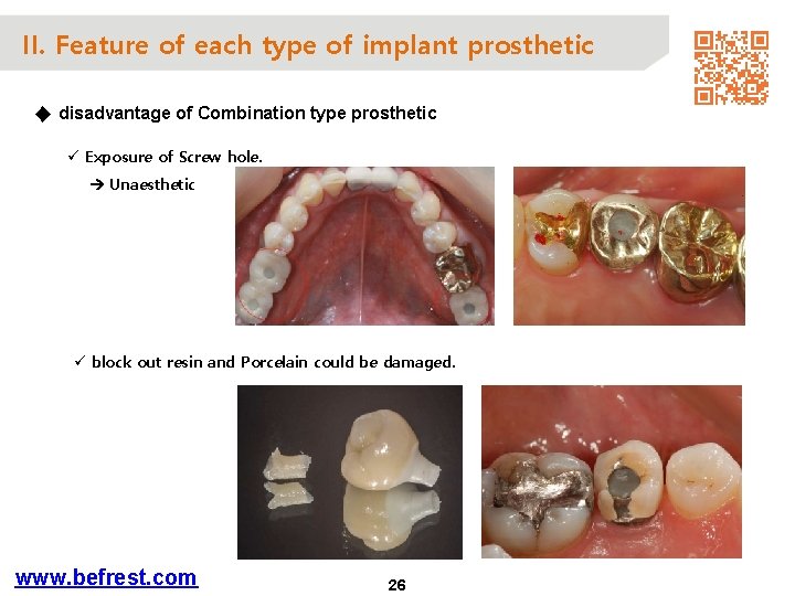 II. Feature of each type of implant prosthetic ◆ disadvantage of Combination type prosthetic