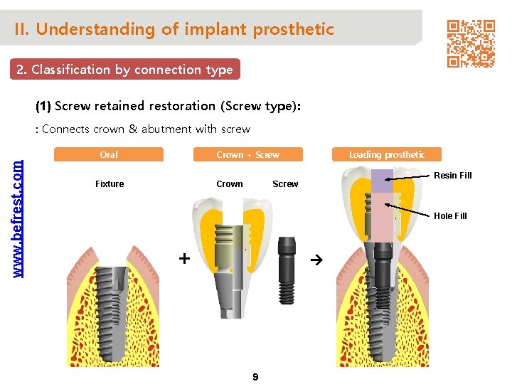 II. Understanding of implant prosthetic 2. Classification by connection type (1) Screw retained restoration