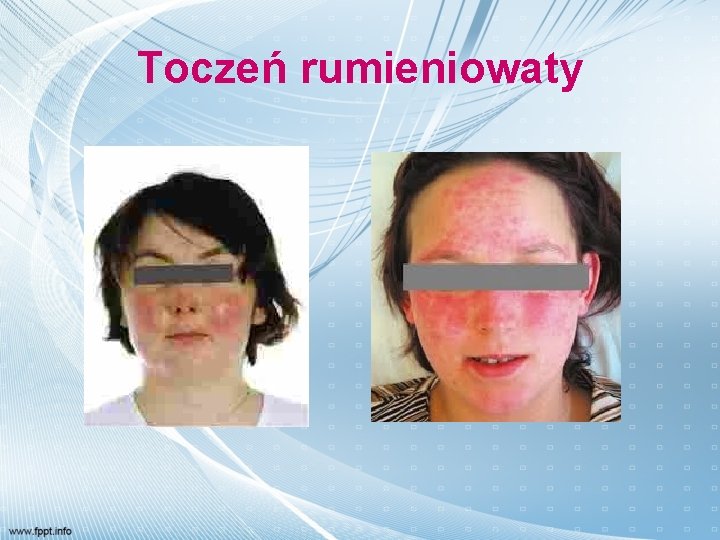 Toczeń rumieniowaty 