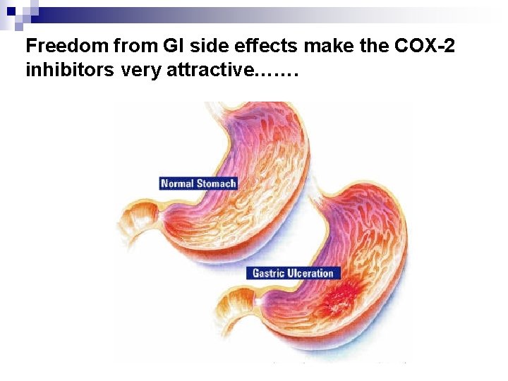 Freedom from GI side effects make the COX-2 inhibitors very attractive……. 