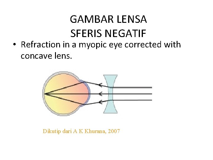 GAMBAR LENSA SFERIS NEGATIF • Refraction in a myopic eye corrected with concave lens.