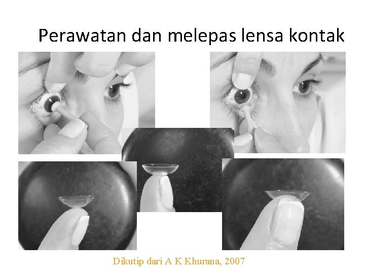 Perawatan dan melepas lensa kontak Dikutip dari A K Khurana, 2007 