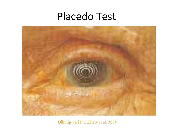 Placedo Test Dikutip dari P T Khaw et al, 2004 