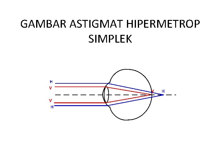 GAMBAR ASTIGMAT HIPERMETROP SIMPLEK 