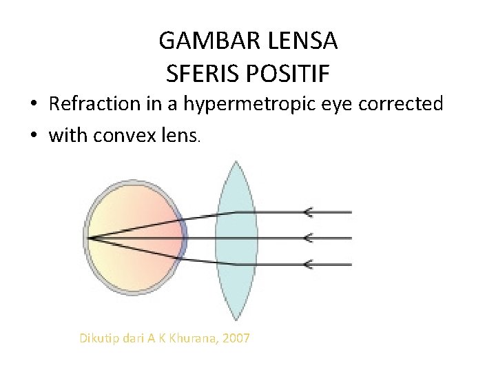 GAMBAR LENSA SFERIS POSITIF • Refraction in a hypermetropic eye corrected • with convex
