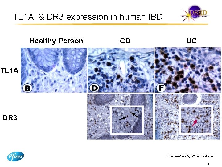 TL 1 A & DR 3 expression in human IBD Healthy Person CD UC