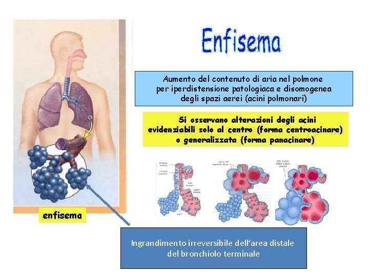 Aumento del contenuto di aria nel polmone per iperdistensione patologiaca e disomogenea degli spazi