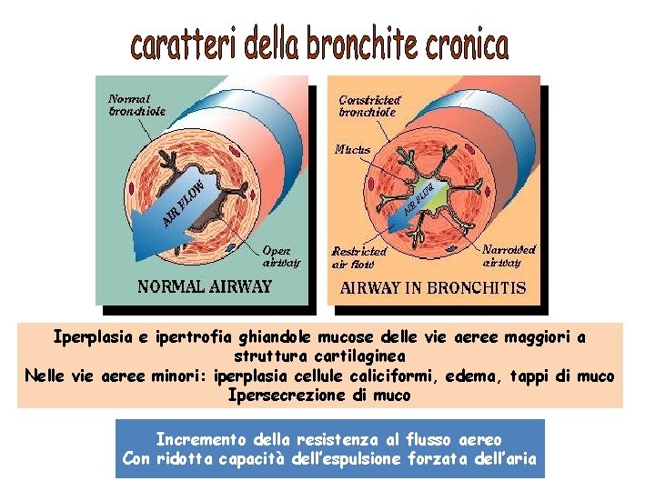 Iperplasia e ipertrofia ghiandole mucose delle vie aeree maggiori a struttura cartilaginea Nelle vie