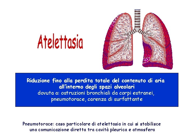 Riduzione fino alla perdita totale del contenuto di aria all’interno degli spazi alveolari dovuta