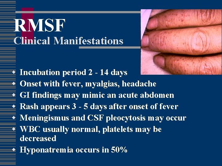 RMSF Clinical Manifestations w w w Incubation period 2 - 14 days Onset with