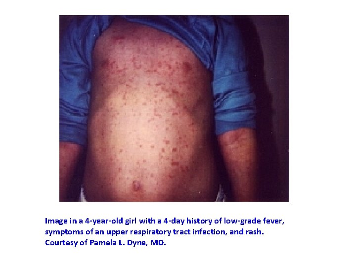 Image in a 4 -year-old girl with a 4 -day history of low-grade fever,