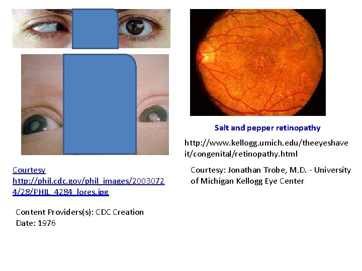 Salt and pepper retinopathy http: //www. kellogg. umich. edu/theeyeshave it/congenital/retinopathy. html Courtesy http: //phil.