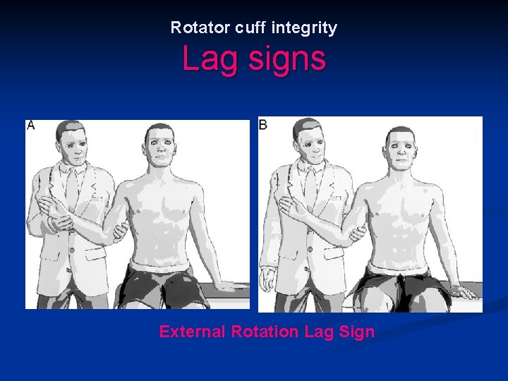 Rotator cuff integrity Lag signs External Rotation Lag Sign 