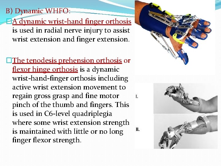 B) Dynamic WHFO: �A dynamic wrist-hand finger orthosis is used in radial nerve injury