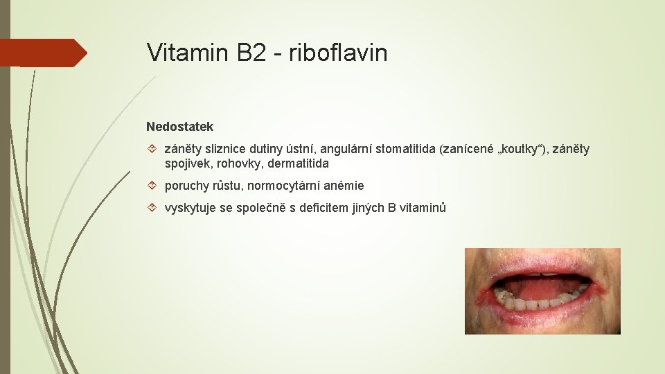 Vitamin B 2 - riboflavin Nedostatek záněty sliznice dutiny ústní, angulární stomatitida (zanícené „koutky“),