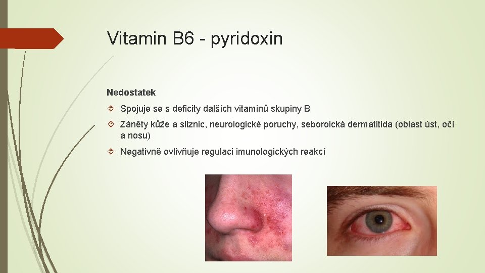 Vitamin B 6 - pyridoxin Nedostatek Spojuje se s deficity dalších vitaminů skupiny B