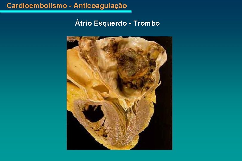 Cardioembolismo - Anticoagulação Átrio Esquerdo - Trombo 