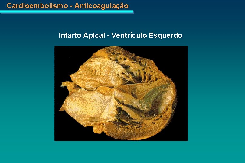 Cardioembolismo - Anticoagulação Infarto Apical - Ventrículo Esquerdo 