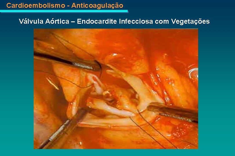 Cardioembolismo - Anticoagulação Válvula Aórtica – Endocardite Infecciosa com Vegetações 