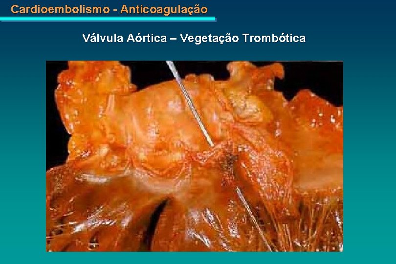 Cardioembolismo - Anticoagulação Válvula Aórtica – Vegetação Trombótica 