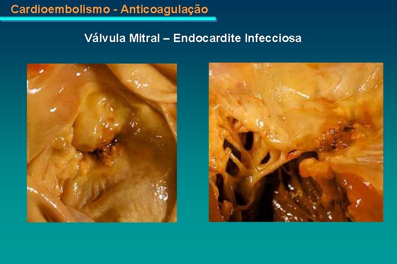 Cardioembolismo - Anticoagulação Válvula Mitral – Endocardite Infecciosa 