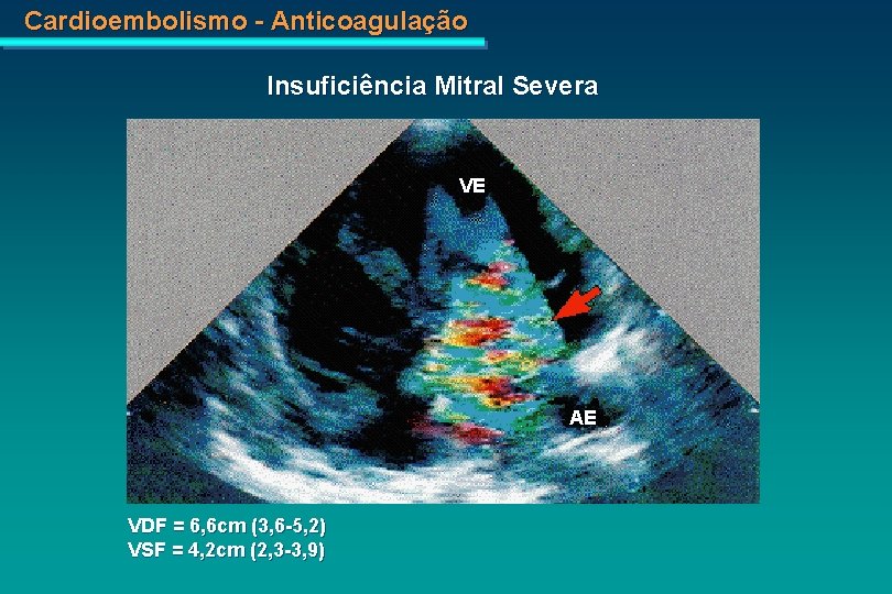 Cardioembolismo - Anticoagulação Insuficiência Mitral Severa VE AE VDF = 6, 6 cm (3,