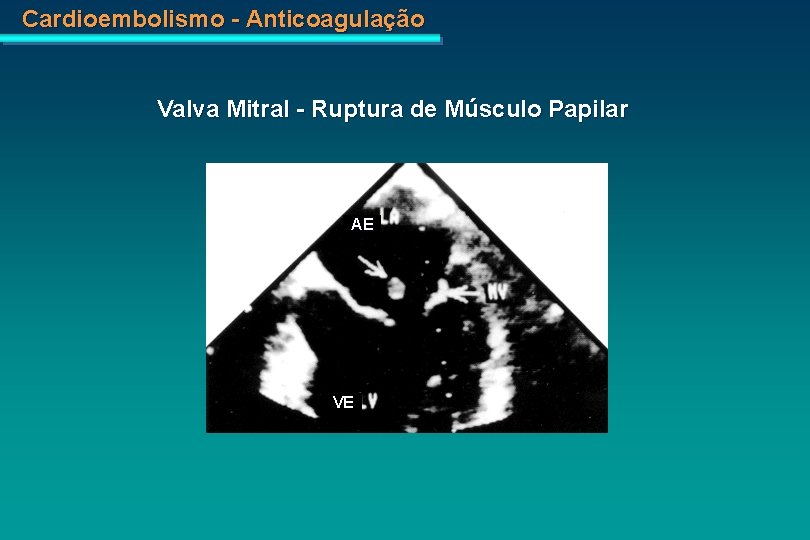 Cardioembolismo - Anticoagulação Valva Mitral - Ruptura de Músculo Papilar AE VE 