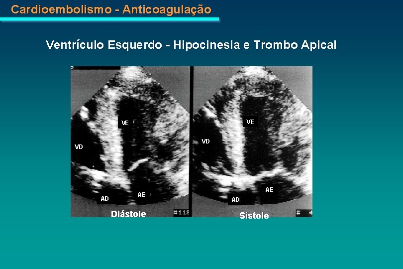 Cardioembolismo - Anticoagulação Ventrículo Esquerdo - Hipocinesia e Trombo Apical VE VE VD VD