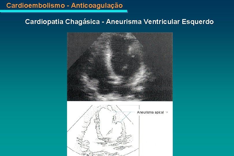 Cardioembolismo - Anticoagulação Cardiopatia Chagásica - Aneurisma Ventricular Esquerdo Aneurisma apical 
