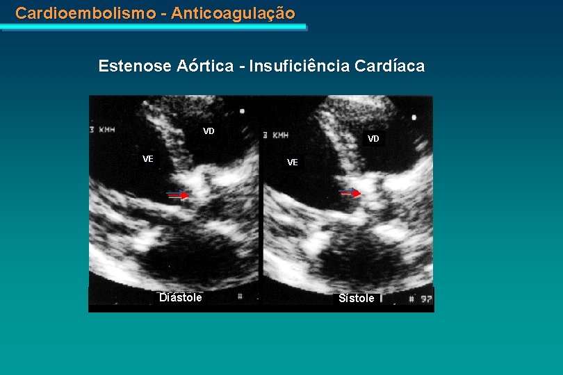 Cardioembolismo - Anticoagulação Estenose Aórtica - Insuficiência Cardíaca VD VE Diástole Sístole 