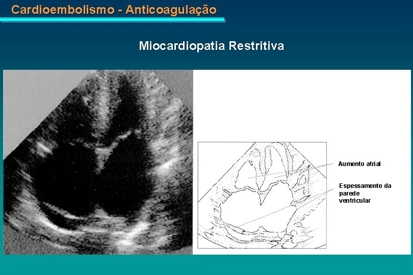 Cardioembolismo - Anticoagulação Miocardiopatia Restritiva Aumento atrial Espessamento da parede ventricular 