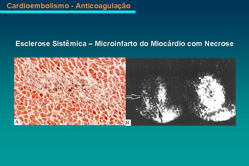 Cardioembolismo - Anticoagulação Esclerose Sistêmica – Microinfarto do Miocárdio com Necrose 