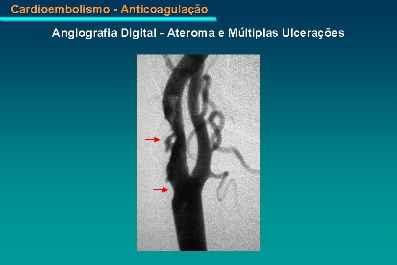 Cardioembolismo - Anticoagulação Angiografia Digital - Ateroma e Múltiplas Ulcerações 