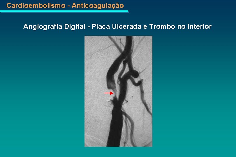 Cardioembolismo - Anticoagulação Angiografia Digital - Placa Ulcerada e Trombo no Interior 