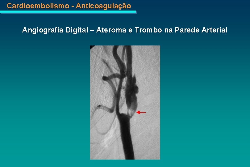 Cardioembolismo - Anticoagulação Angiografia Digital – Ateroma e Trombo na Parede Arterial 