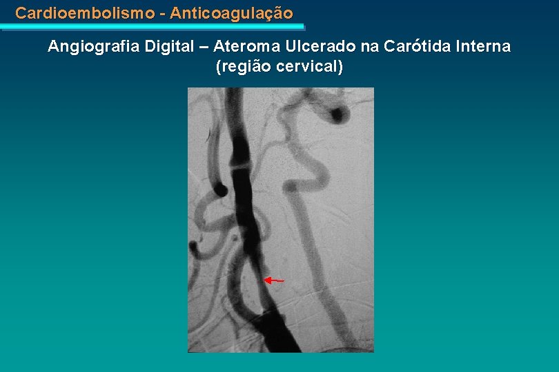 Cardioembolismo - Anticoagulação Angiografia Digital – Ateroma Ulcerado na Carótida Interna (região cervical) 