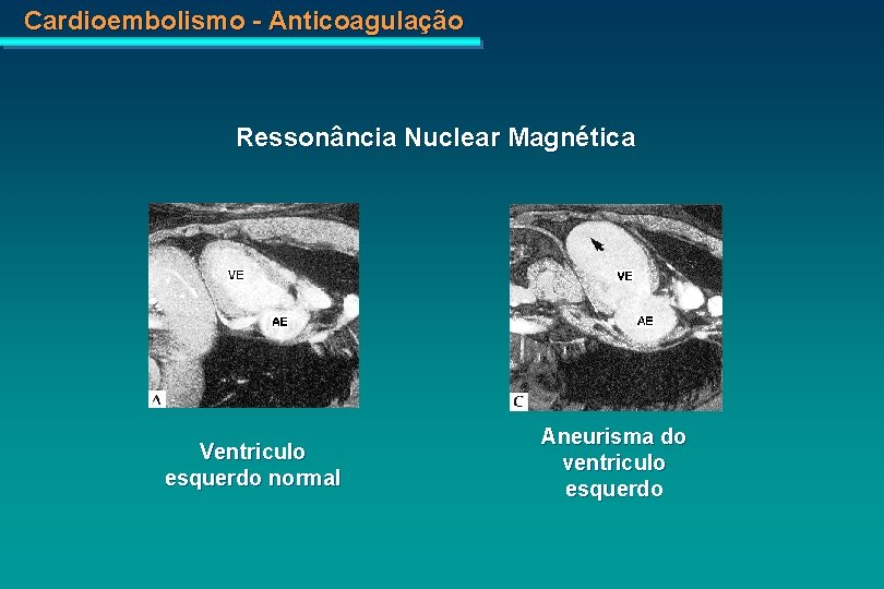 Cardioembolismo - Anticoagulação Ressonância Nuclear Magnética Ventriculo esquerdo normal Aneurisma do ventriculo esquerdo 