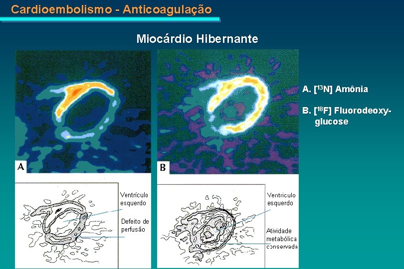 Cardioembolismo - Anticoagulação Miocárdio Hibernante A. [13 N] Amônia B. [18 F] Fluorodeoxy glucose